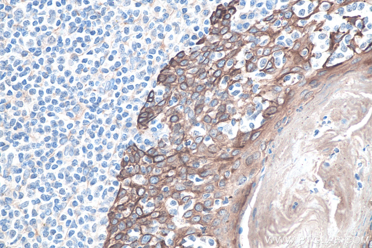 Immunohistochemistry (IHC) staining of human tonsillitis tissue using Cytokeratin 8 Polyclonal antibody (10384-1-AP)