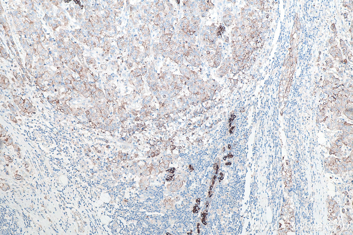 IHC staining of human breast cancer using 10384-1-AP Immunohistochemistry (IHC) staining of human breast cancer tissue using Cytokeratin 8 Polyclonal antibody (10384-1-AP)