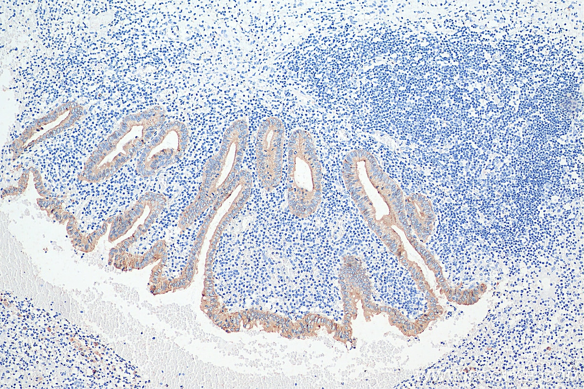 Immunohistochemistry (IHC) staining of human appendicitis tissue using Cytokeratin 8 Polyclonal antibody (10384-1-AP)