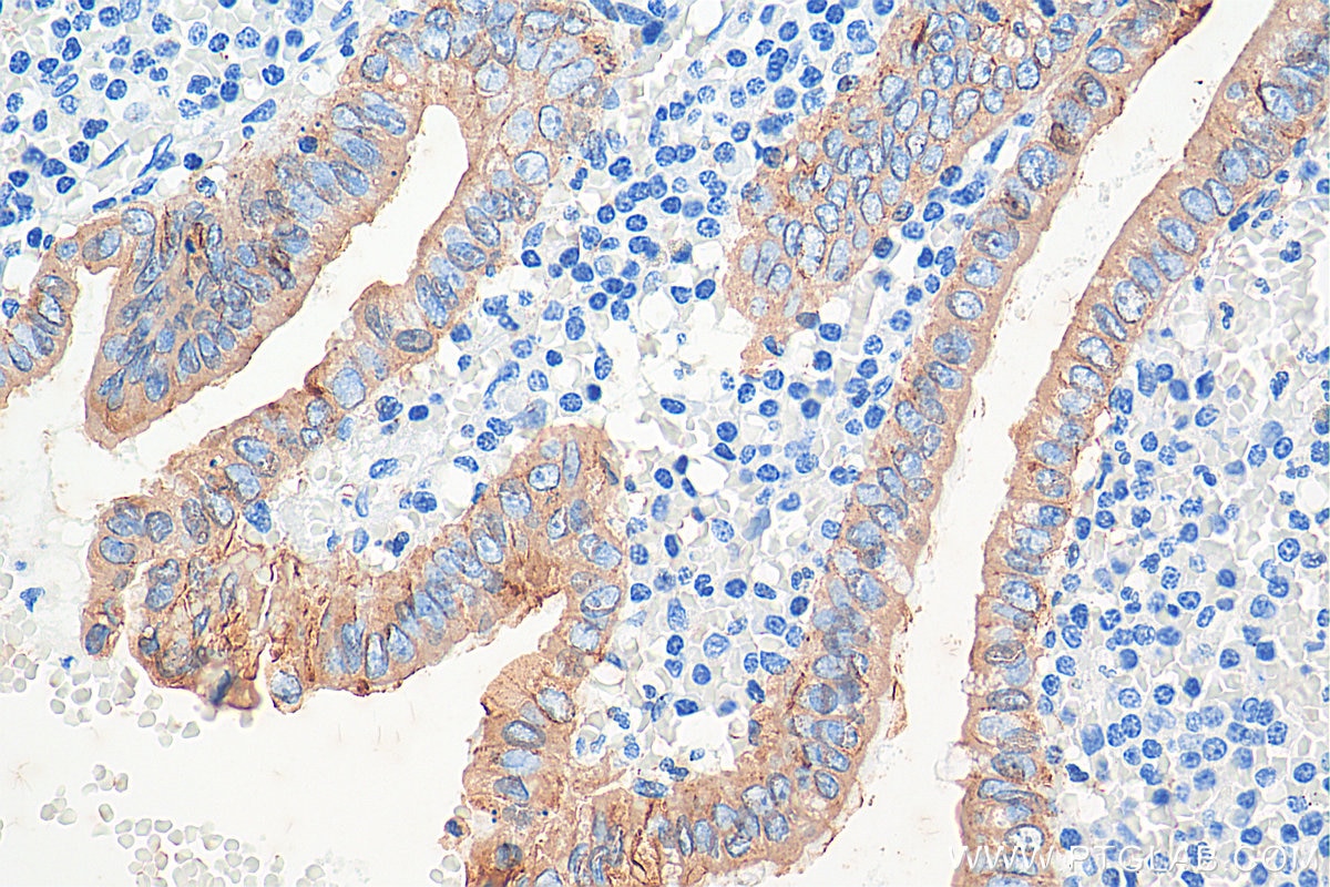 Immunohistochemistry (IHC) staining of human appendicitis tissue using Cytokeratin 8 Polyclonal antibody (10384-1-AP)