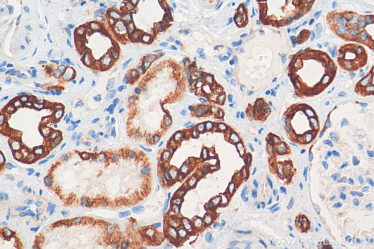 Immunohistochemistry (IHC) staining of human renal cell carcinoma tissue using Cytokeratin 8 Polyclonal antibody (10384-1-AP)