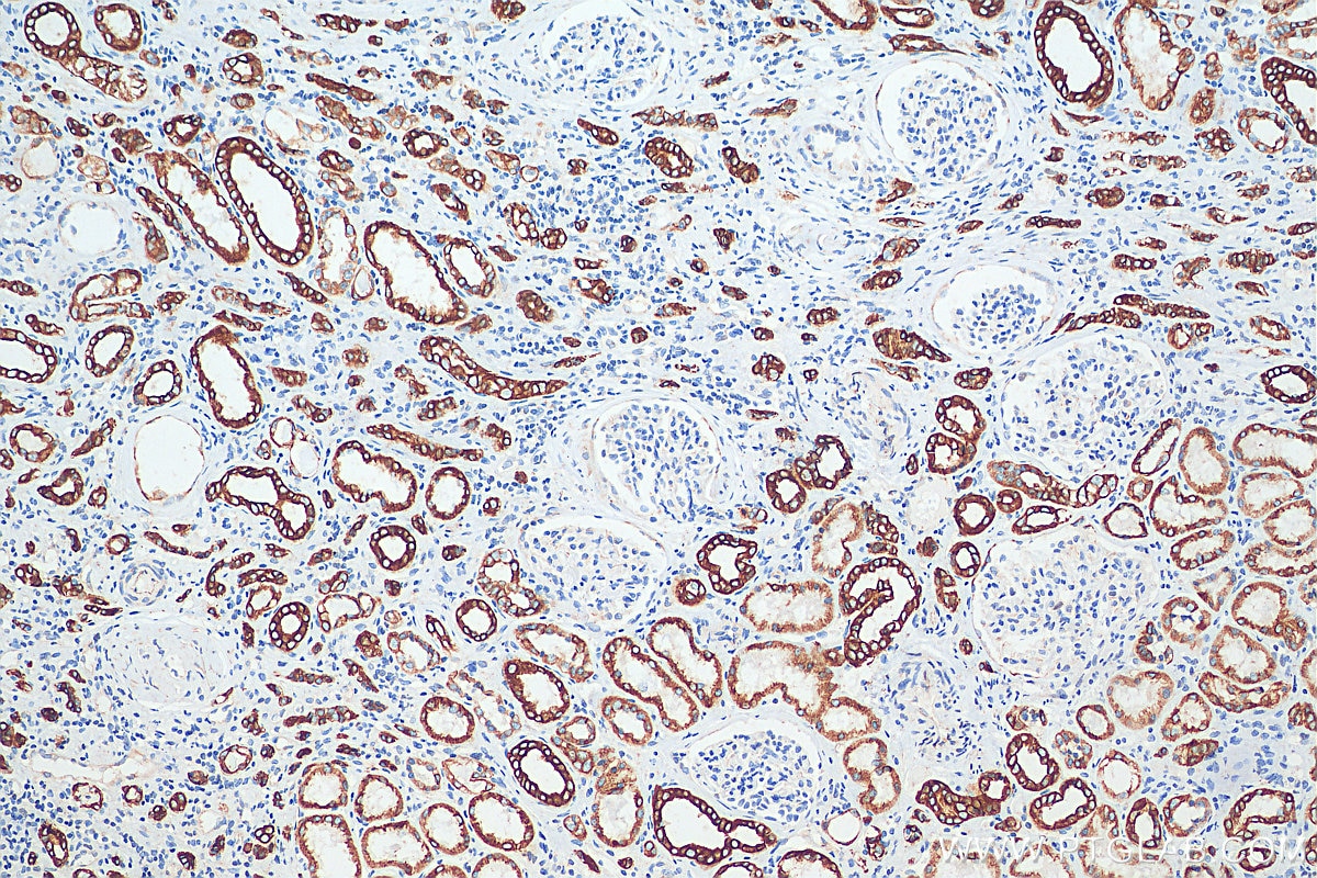 Immunohistochemistry (IHC) staining of human renal cell carcinoma tissue using Cytokeratin 8 Polyclonal antibody (10384-1-AP)