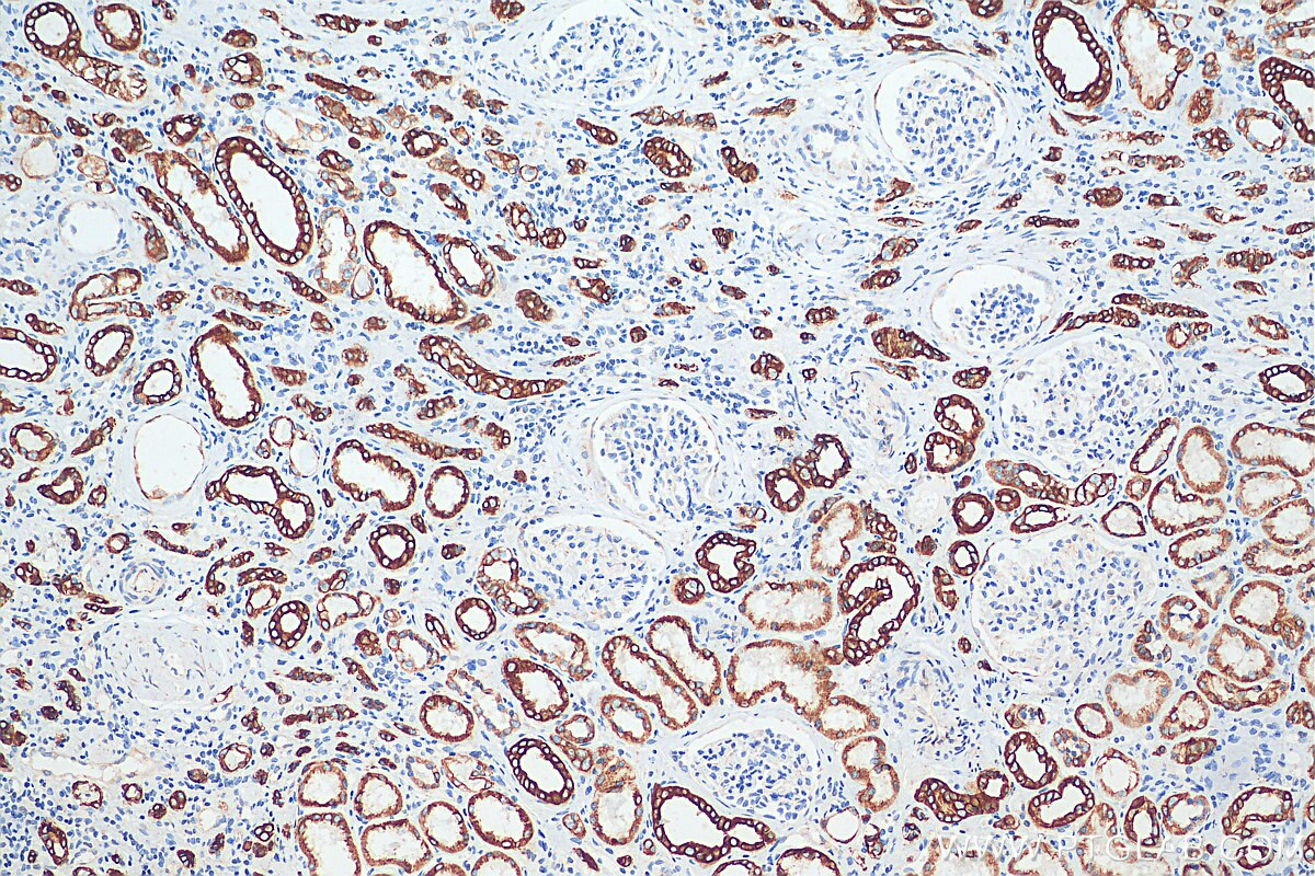 IHC staining of human renal cell carcinoma using 10384-1-AP