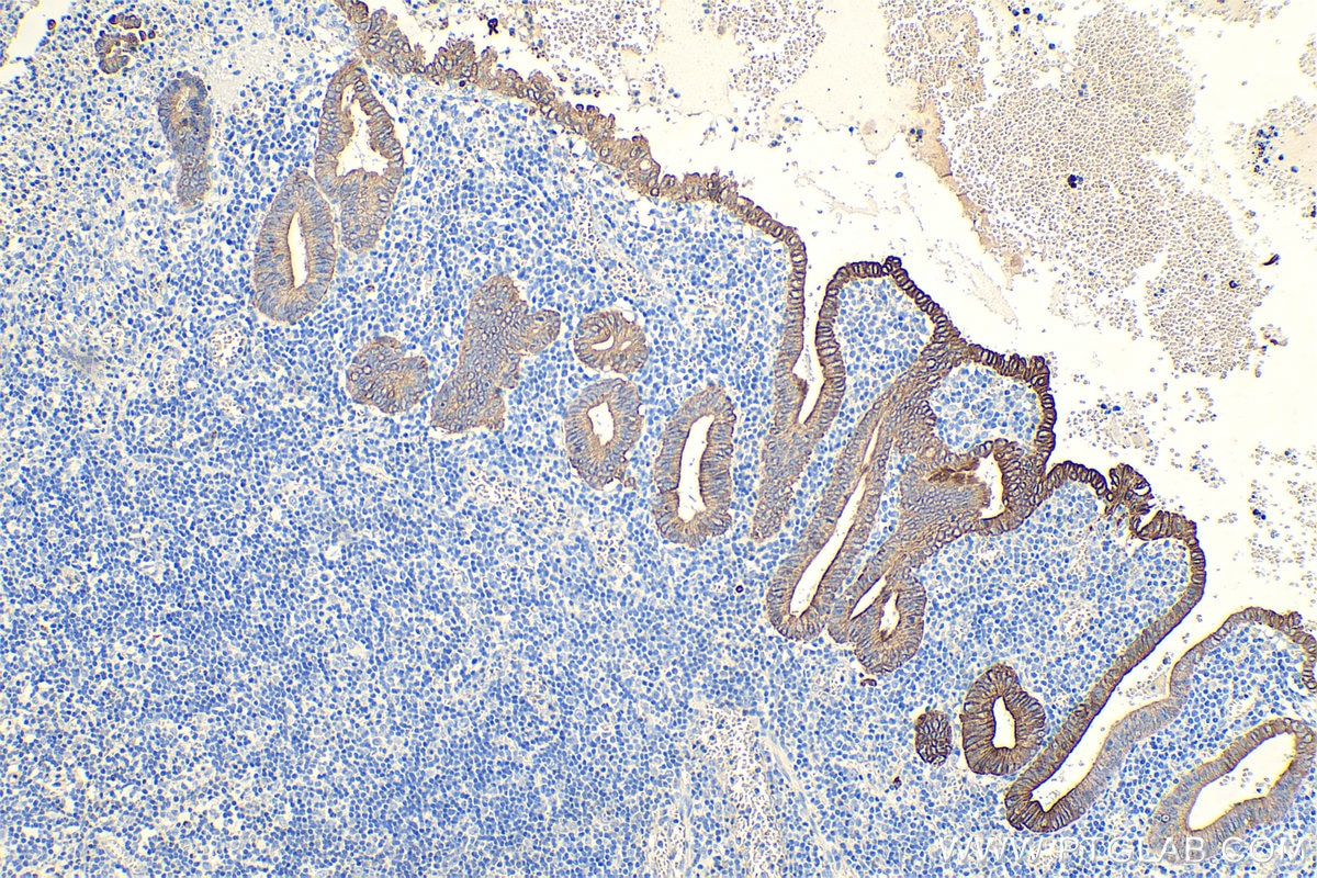 IHC staining of human appendicitis using 10384-1-AP Immunohistochemistry (IHC) staining of human appendicitis tissue using Cytokeratin 8 Polyclonal antibody (10384-1-AP)