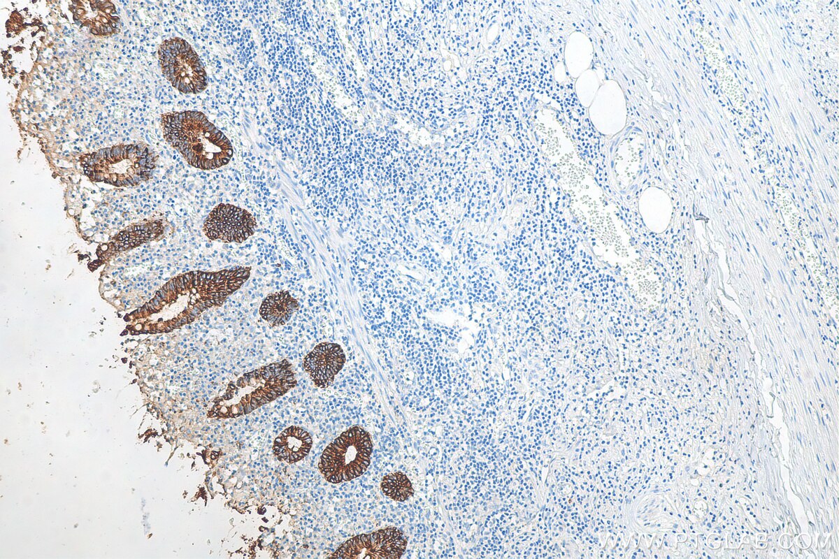 Immunohistochemistry (IHC) staining of human appendicitis tissue using Cytokeratin 8 Polyclonal antibody (10384-1-AP)