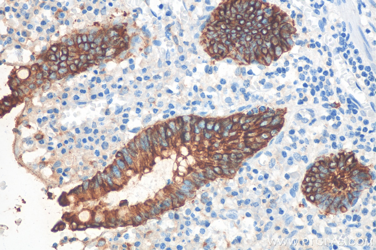 Immunohistochemistry (IHC) staining of human appendicitis tissue using Cytokeratin 8 Polyclonal antibody (10384-1-AP)