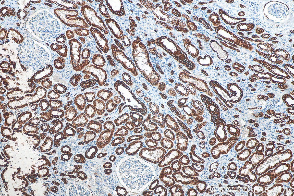 Immunohistochemistry (IHC) staining of human renal cell carcinoma tissue using Cytokeratin 8 Polyclonal antibody (10384-1-AP)