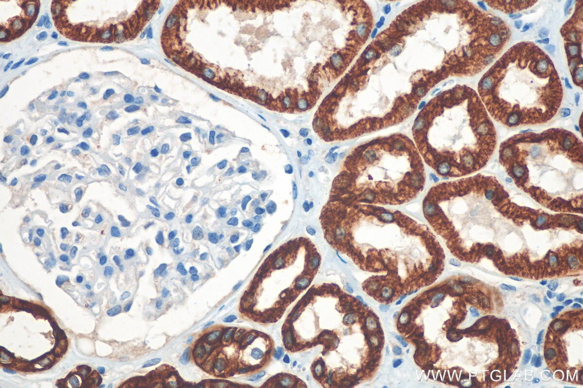 Immunohistochemistry (IHC) staining of human renal cell carcinoma tissue using Cytokeratin 8 Polyclonal antibody (10384-1-AP)