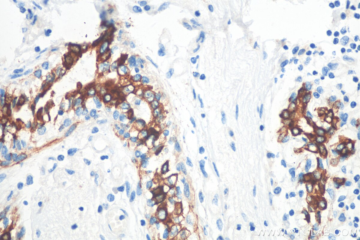 IHC staining of human breast cancer using 10384-1-AP