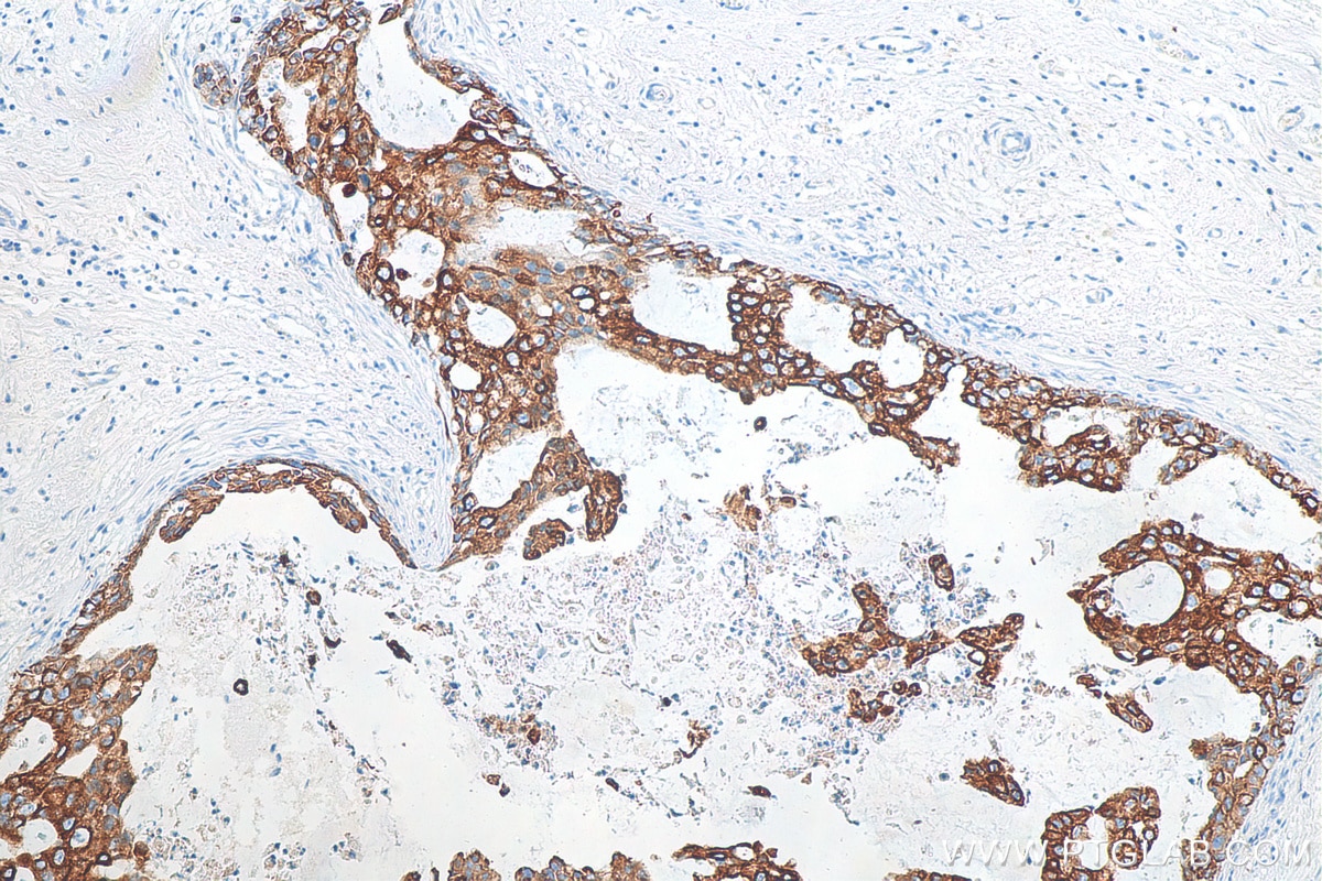 Immunohistochemistry (IHC) staining of human breast cancer tissue using Cytokeratin 8 Polyclonal antibody (10384-1-AP)