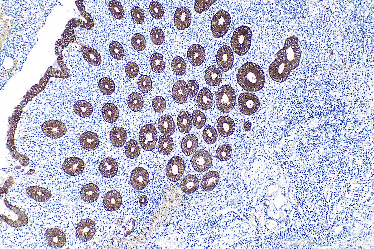 Immunohistochemistry (IHC) staining of human appendicitis tissue using Cytokeratin 8 Polyclonal antibody (10384-1-AP)