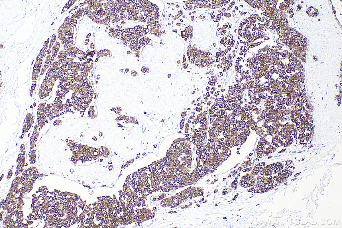 Immunohistochemistry (IHC) staining of human breast cancer tissue using Cytokeratin 8 Polyclonal antibody (10384-1-AP)