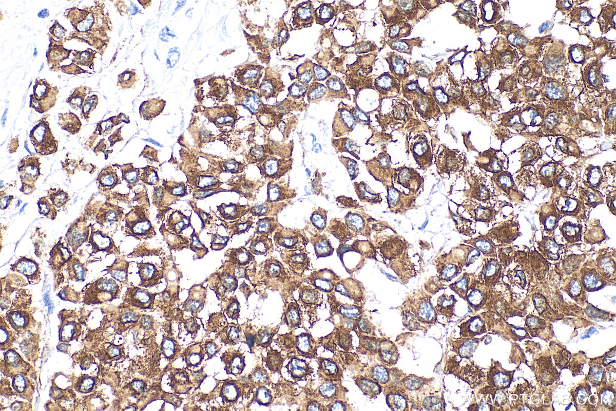Immunohistochemistry (IHC) staining of human breast cancer tissue using Cytokeratin 8 Polyclonal antibody (10384-1-AP)