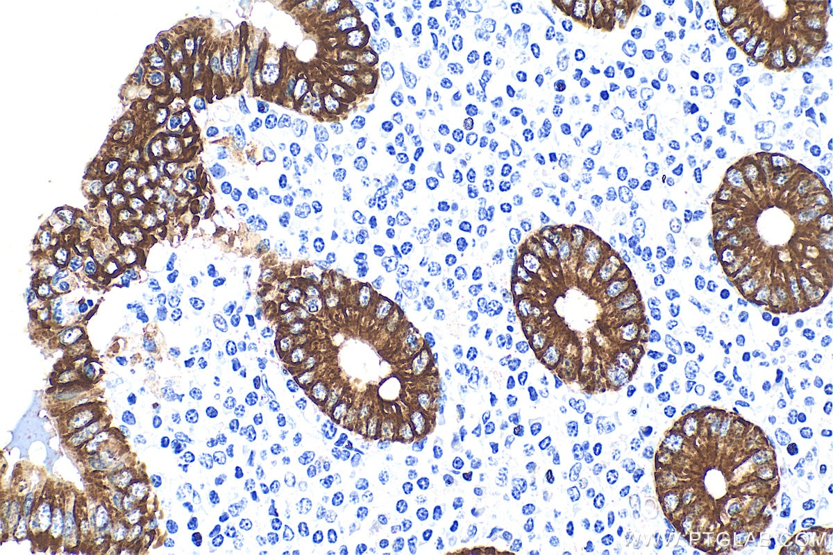 Immunohistochemistry (IHC) staining of human appendicitis tissue using Cytokeratin 8 Polyclonal antibody (10384-1-AP)