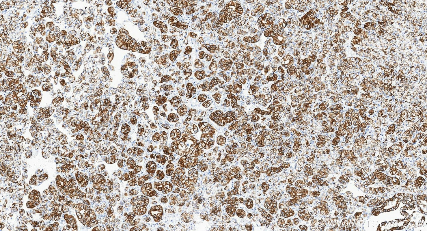 Immunohistochemistry (IHC) staining of human renal cell carcinoma tissue using Cytokeratin 8 Polyclonal antibody (10384-1-AP)
