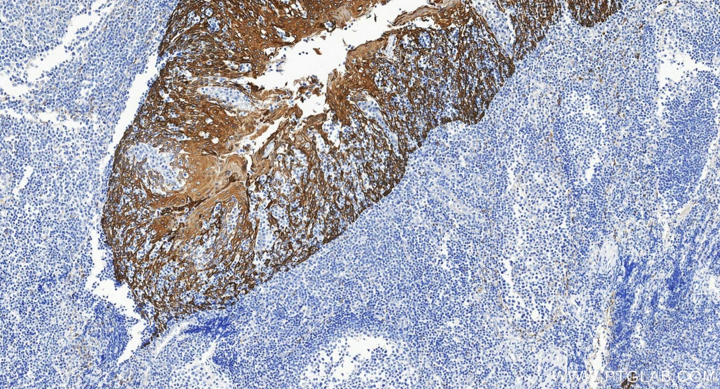 Immunohistochemistry (IHC) staining of human tonsillitis tissue using Cytokeratin 8 Polyclonal antibody (10384-1-AP)