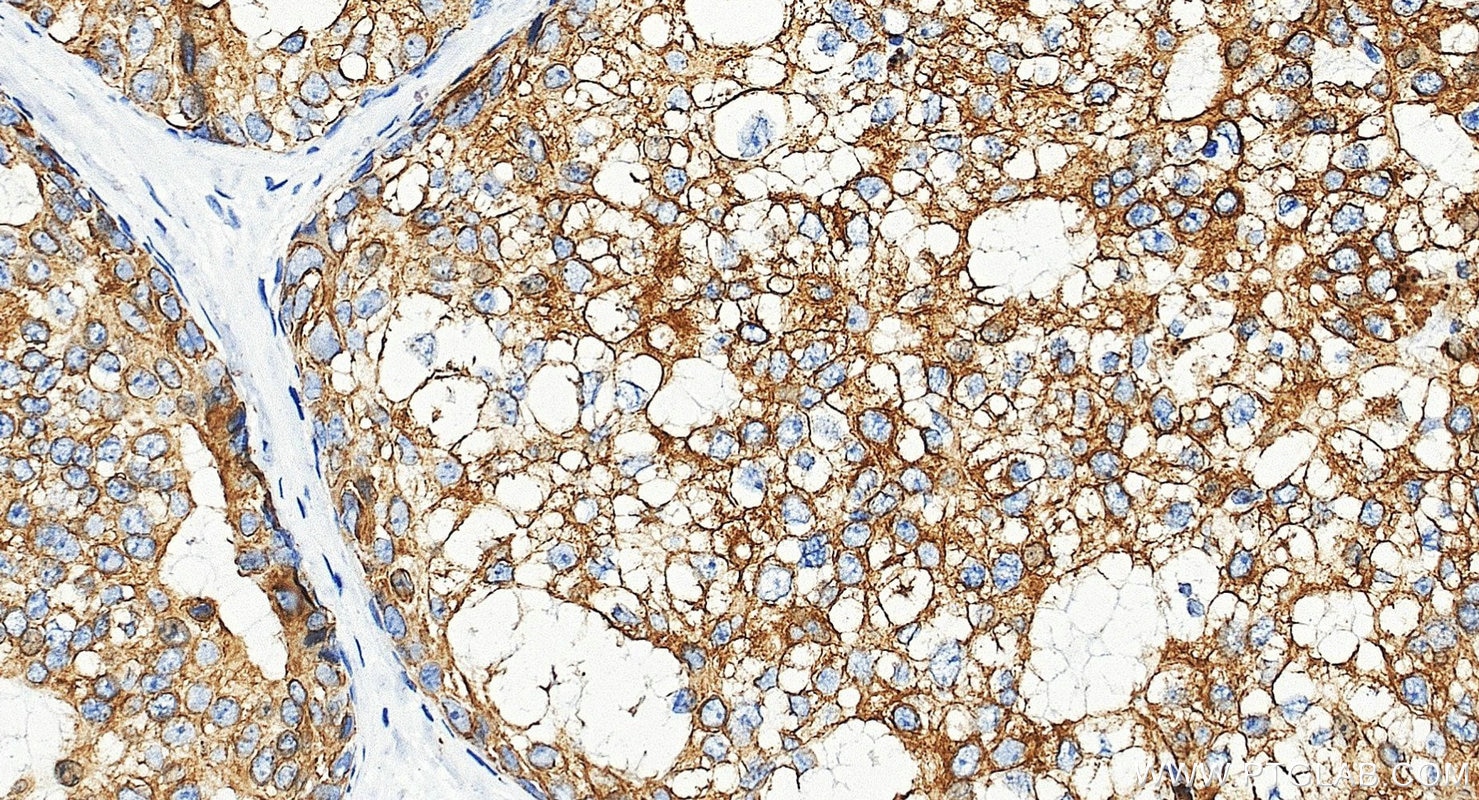 Immunohistochemistry (IHC) staining of human breast cancer tissue using Cytokeratin 8 Polyclonal antibody (10384-1-AP)