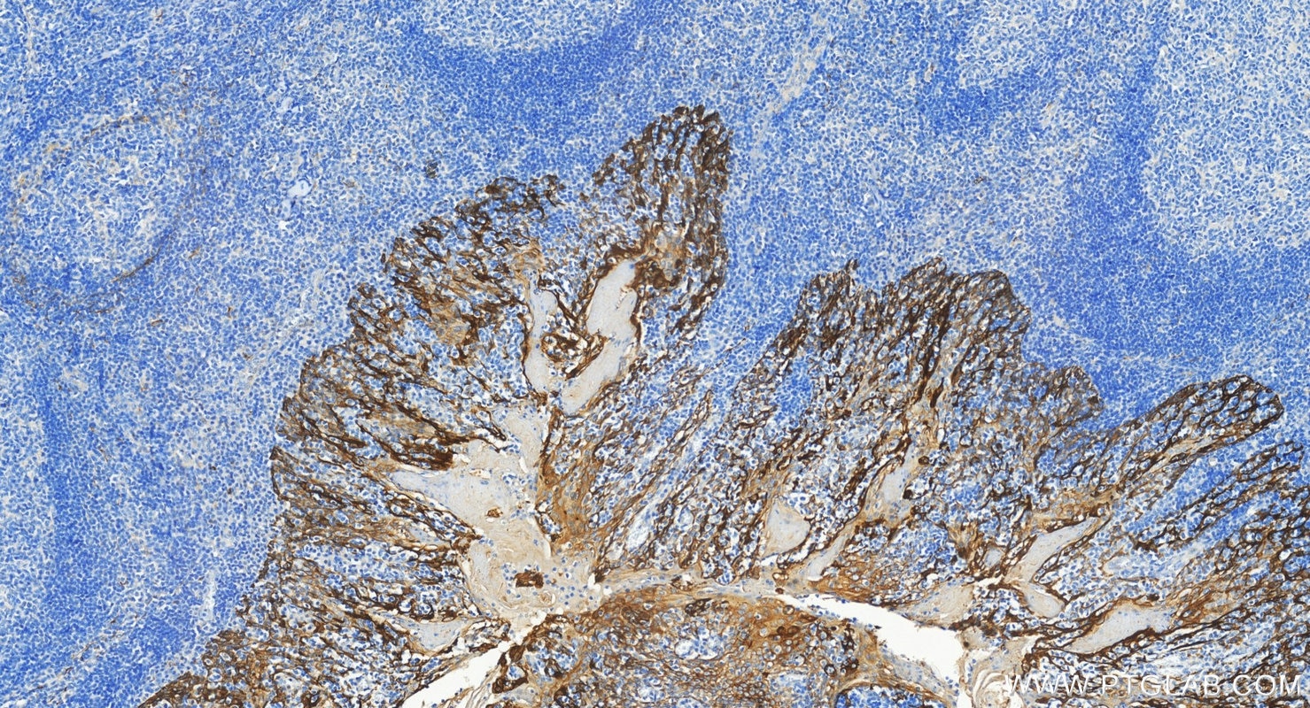Immunohistochemistry (IHC) staining of human tonsillitis tissue using Cytokeratin 8 Polyclonal antibody (10384-1-AP)