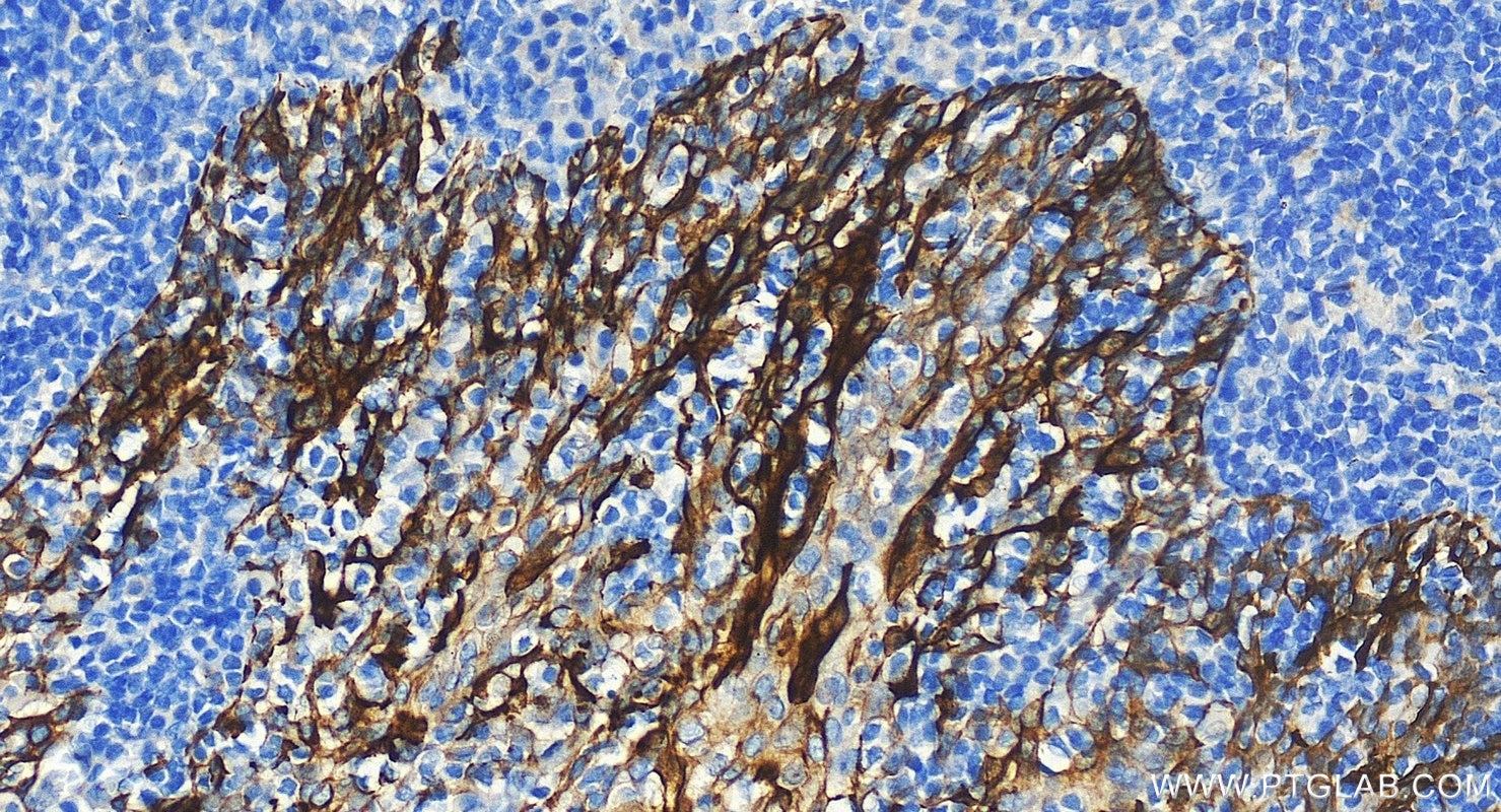 Immunohistochemistry (IHC) staining of human tonsillitis tissue using Cytokeratin 8 Polyclonal antibody (10384-1-AP)