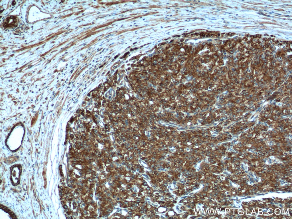 Immunohistochemistry (IHC) staining of human prostate cancer tissue using Cytokeratin 8 Polyclonal antibody (17514-1-AP)