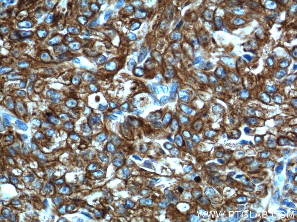 Immunohistochemistry (IHC) staining of human prostate cancer tissue using Cytokeratin 8 Polyclonal antibody (17514-1-AP)