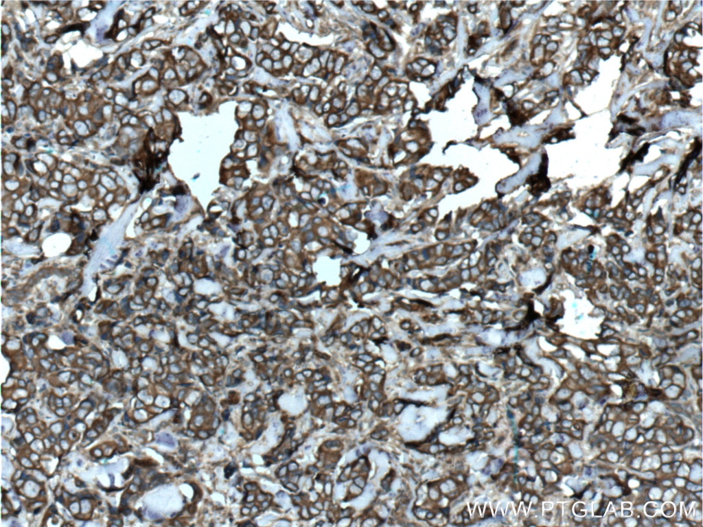 IHC staining of human breast cancer using 17514-1-AP