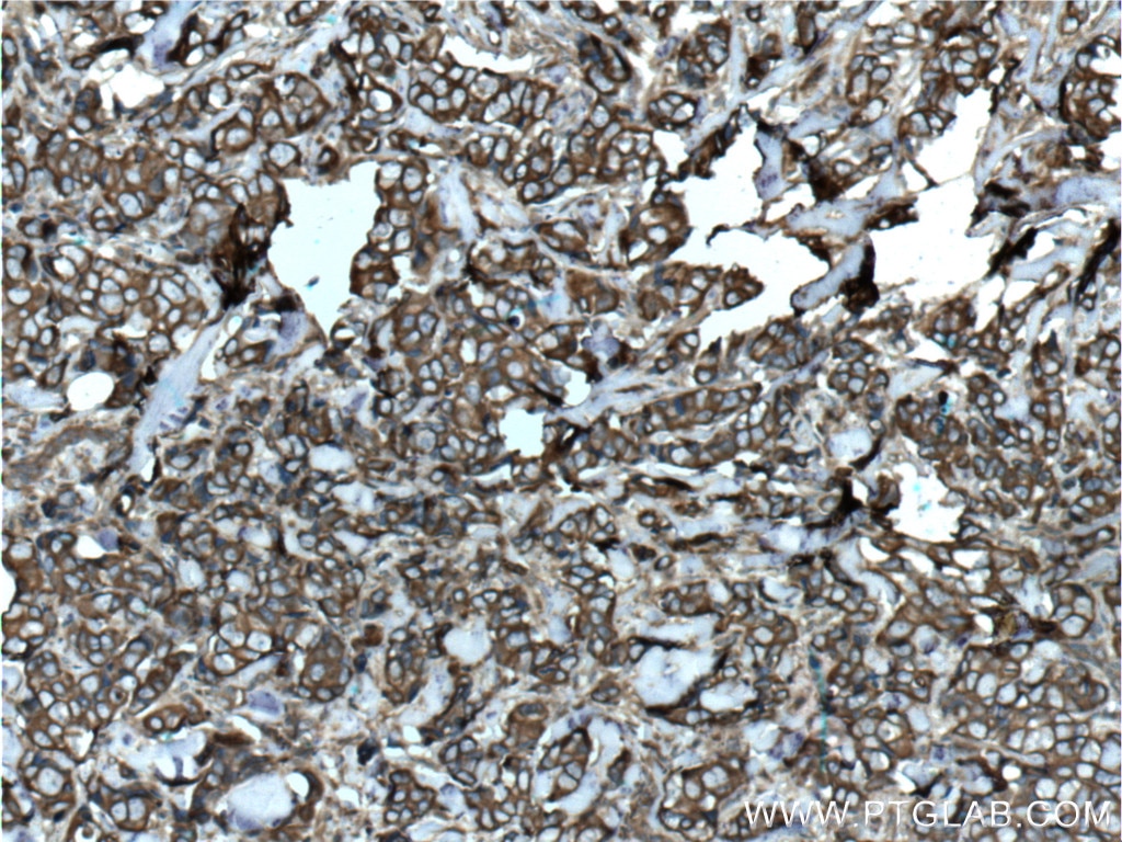 Immunohistochemistry (IHC) staining of human breast cancer tissue using Cytokeratin 8 Polyclonal antibody (17514-1-AP)