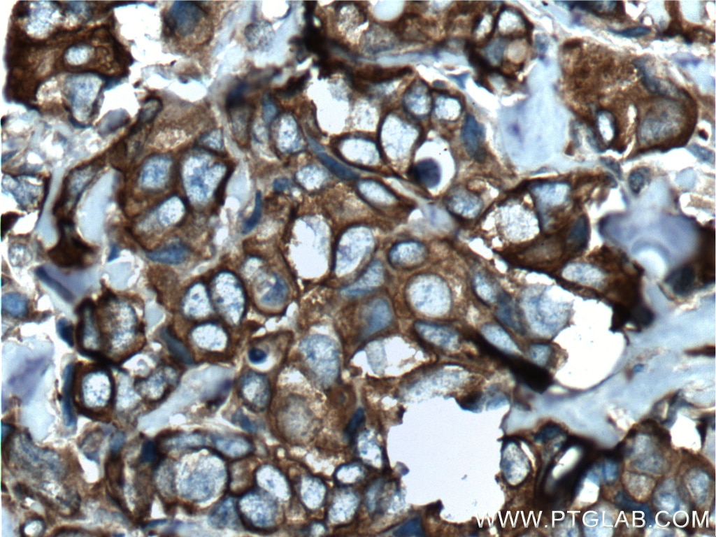 Immunohistochemistry (IHC) staining of human breast cancer tissue using Cytokeratin 8 Polyclonal antibody (17514-1-AP)