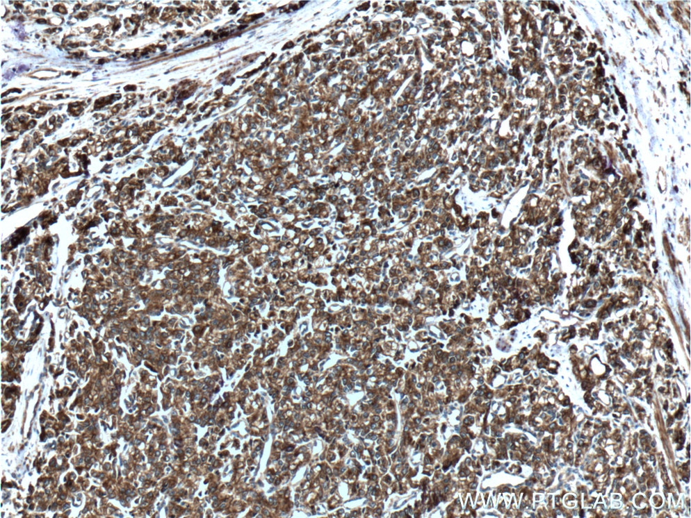 Immunohistochemistry (IHC) staining of human prostate cancer tissue using Cytokeratin 8 Polyclonal antibody (17514-1-AP)