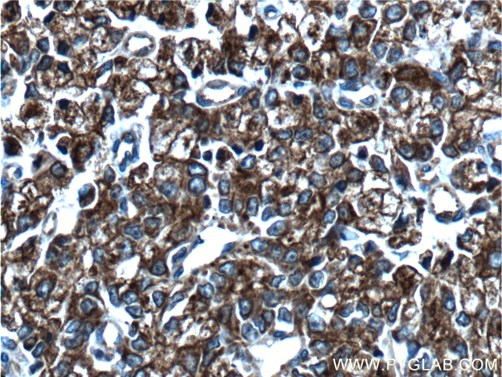Immunohistochemistry (IHC) staining of human prostate cancer tissue using Cytokeratin 8 Polyclonal antibody (17514-1-AP)