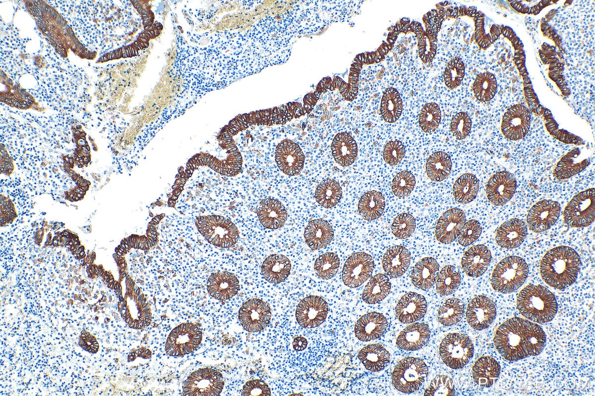 Immunohistochemistry (IHC) staining of human appendicitis tissue using Cytokeratin 8 Polyclonal antibody (17514-1-AP)