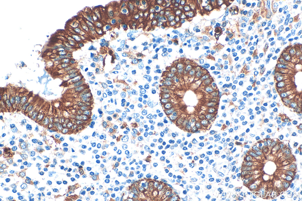 Immunohistochemistry (IHC) staining of human appendicitis tissue using Cytokeratin 8 Polyclonal antibody (17514-1-AP)