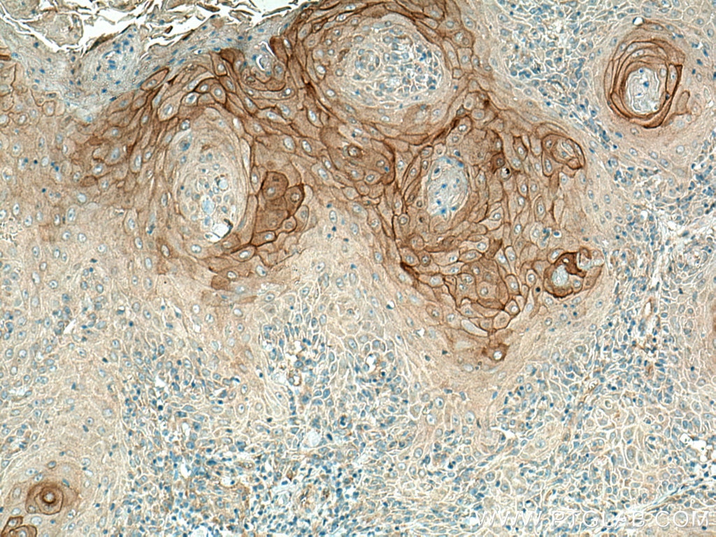 Immunohistochemistry (IHC) staining of human skin cancer tissue using KRT80 Polyclonal antibody (16835-1-AP)
