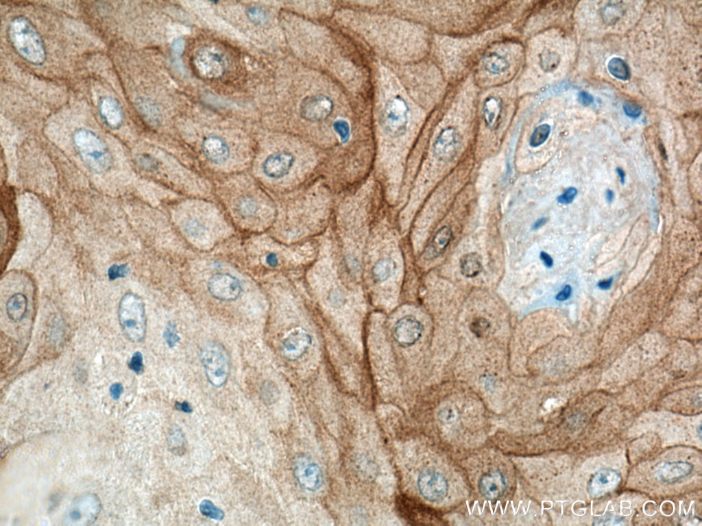 Immunohistochemistry (IHC) staining of human skin cancer tissue using KRT80 Polyclonal antibody (16835-1-AP)