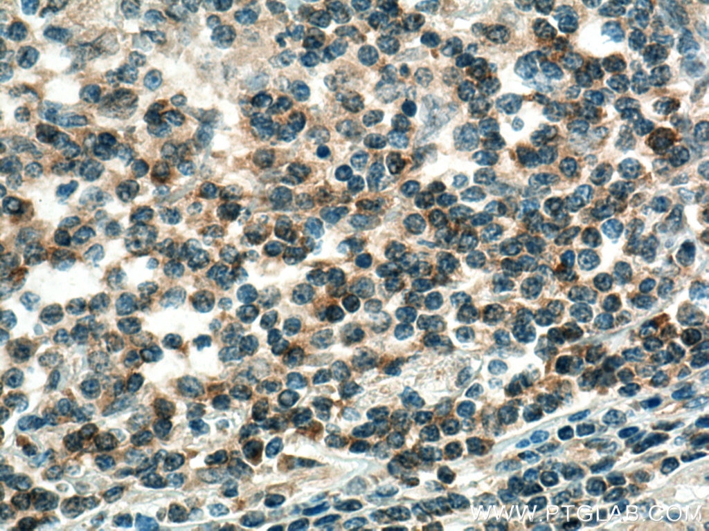 Immunohistochemistry (IHC) staining of human colon cancer tissue using KRT80 Polyclonal antibody (16835-1-AP)