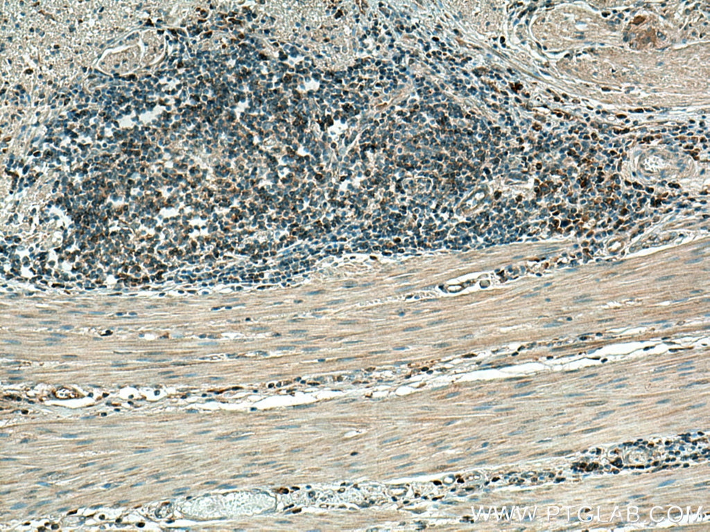 Immunohistochemistry (IHC) staining of human colon cancer tissue using KRT80 Polyclonal antibody (16835-1-AP)