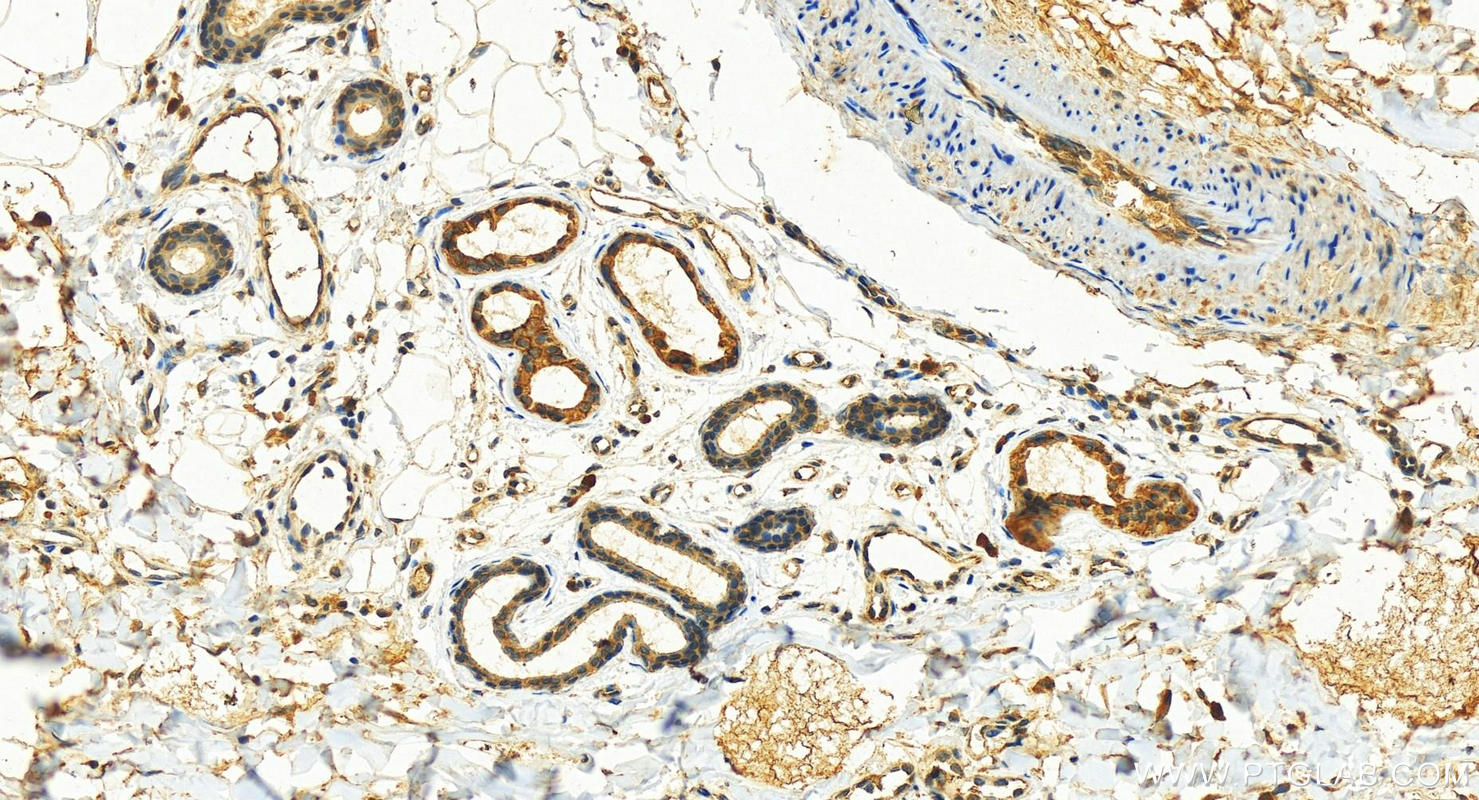 Immunohistochemistry (IHC) staining of human bowen disease tissue using Cytokeratin 80 Polyclonal antibody (16835-1-AP)