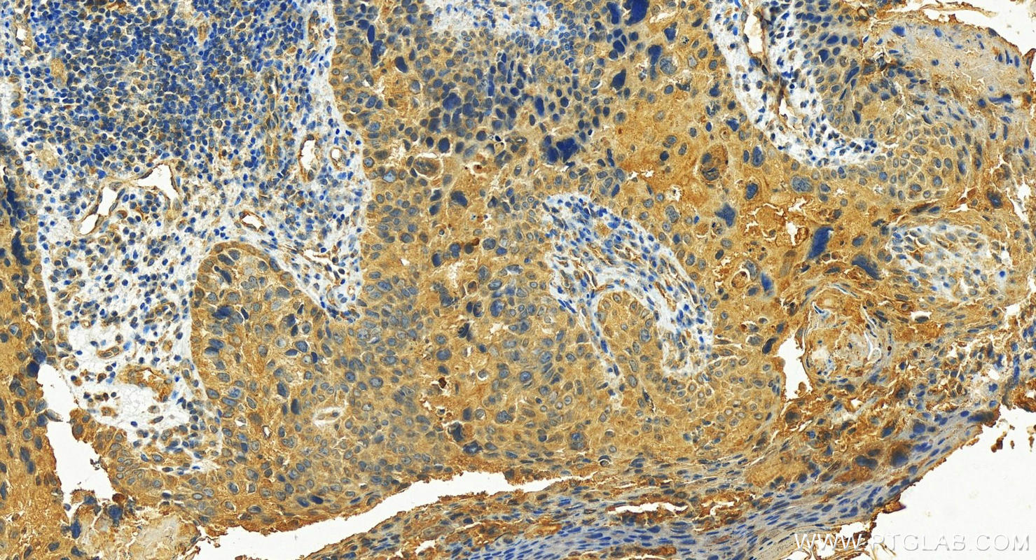 Immunohistochemistry (IHC) staining of human bowen disease tissue using Cytokeratin 80 Polyclonal antibody (16835-1-AP)