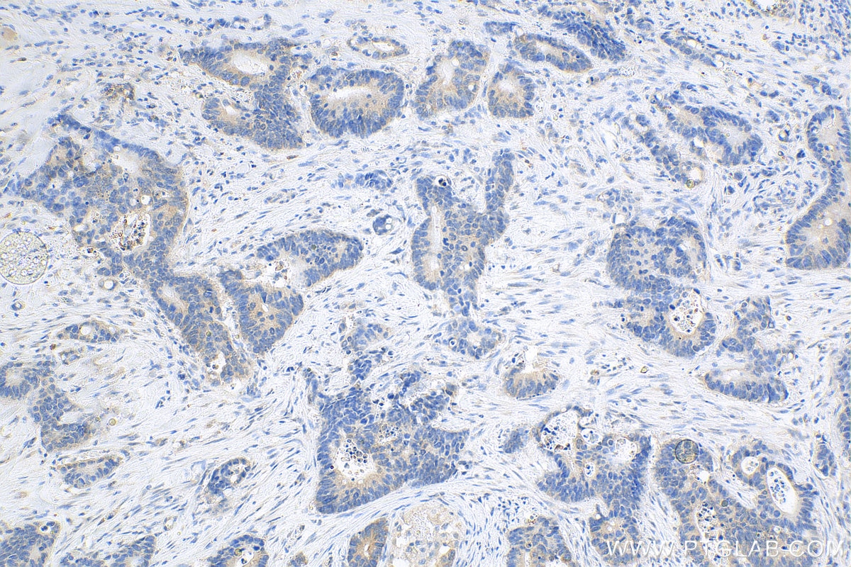 Immunohistochemistry (IHC) staining of human colon cancer tissue using Biotin-conjugated KRT80 Polyclonal antibody (Biotin-16835)