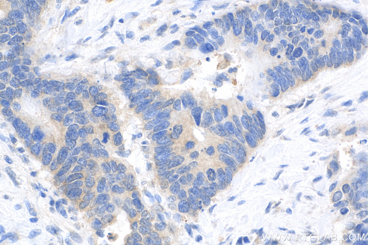 IHC staining of human colon cancer using Biotin-16835