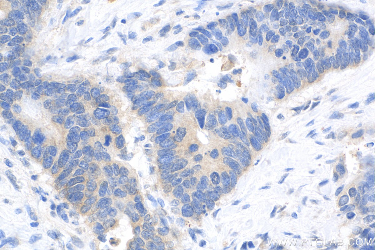 Immunohistochemistry (IHC) staining of human colon cancer tissue using Biotin-conjugated KRT80 Polyclonal antibody (Biotin-16835)