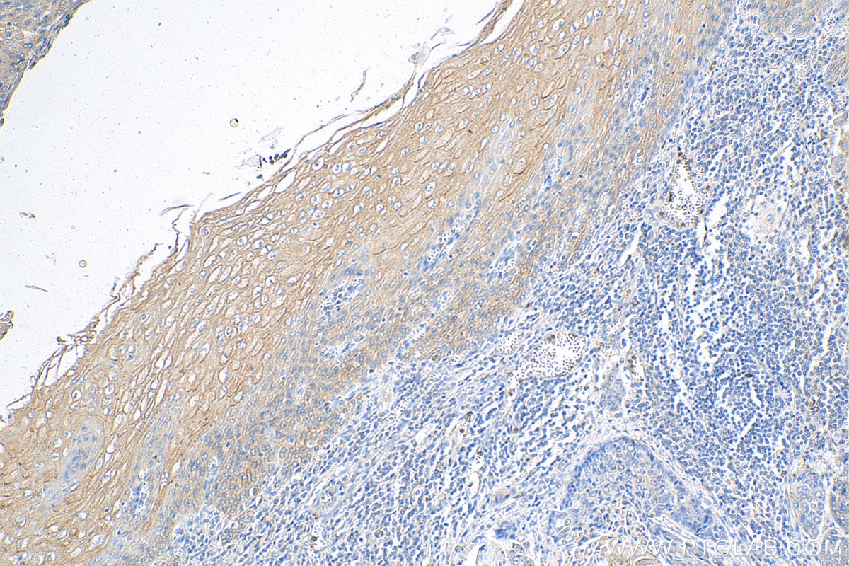 Immunohistochemistry (IHC) staining of human oesophagus cancer tissue using Biotin-conjugated KRT80 Polyclonal antibody (Biotin-16835)