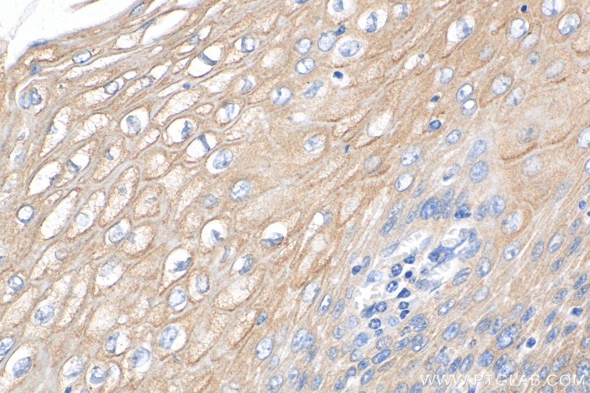 Immunohistochemistry (IHC) staining of human oesophagus cancer tissue using Biotin-conjugated KRT80 Polyclonal antibody (Biotin-16835)