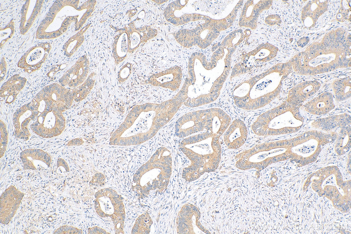 Immunohistochemistry (IHC) staining of human colon cancer tissue using Biotin-conjugated KRT80 Polyclonal antibody (Biotin-16835)