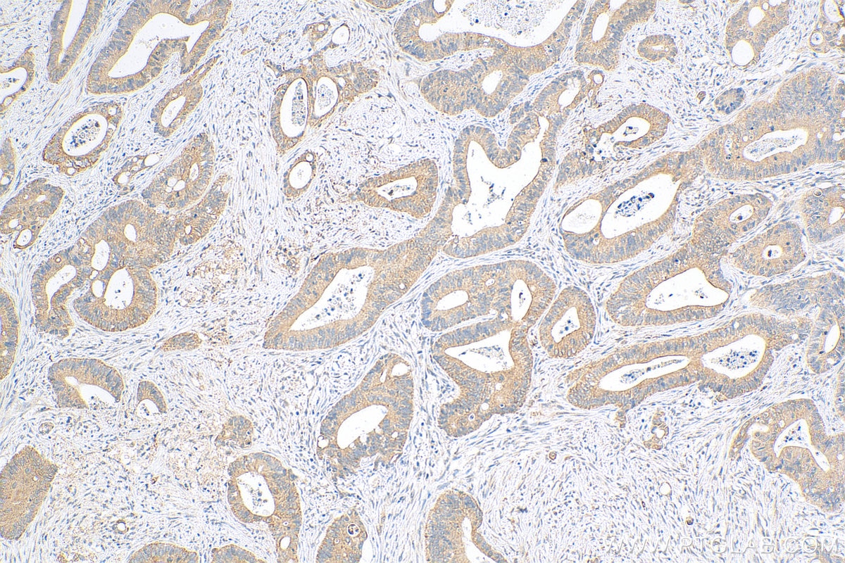 IHC staining of human colon cancer using Biotin-16835