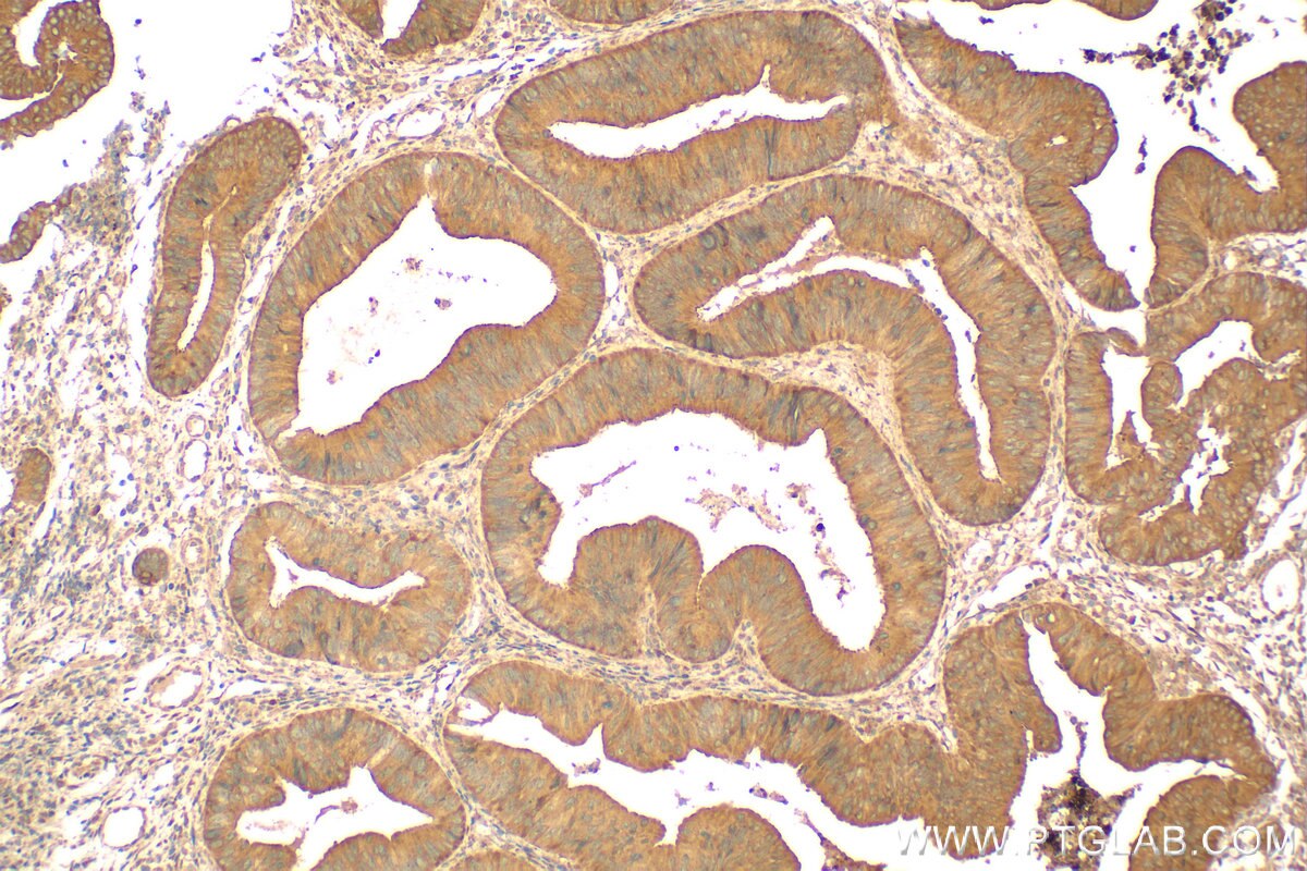Immunohistochemistry (IHC) staining of human colon  cancer using Biotin-conjugated KRT80 Polyclonal antibody (Biotin-16835)