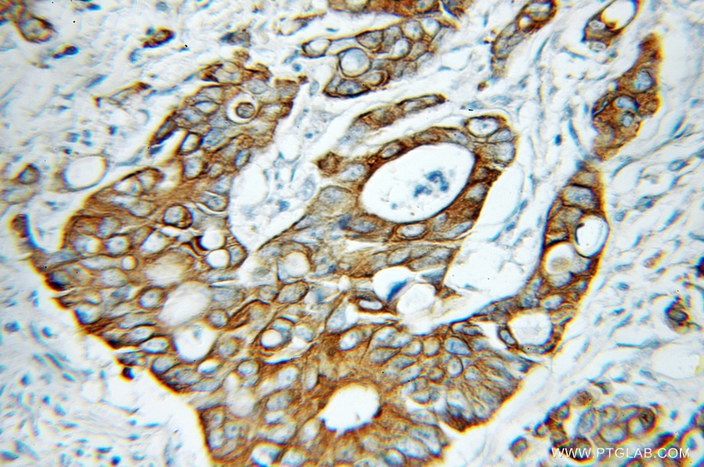 Immunohistochemistry (IHC) staining of human colon cancer tissue using KRT81 Polyclonal antibody (11342-1-AP)