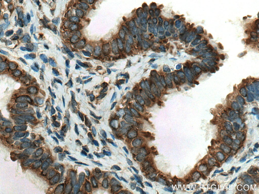 Immunohistochemistry (IHC) staining of human ovary tumor tissue using KTN1 Polyclonal antibody (19841-1-AP)