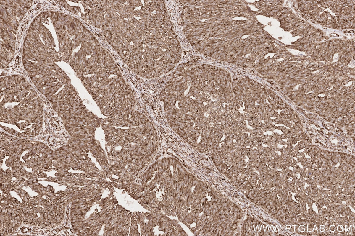 Immunohistochemistry (IHC) staining of human ovary cancer tissue using KTN1 Polyclonal antibody (19841-1-AP)