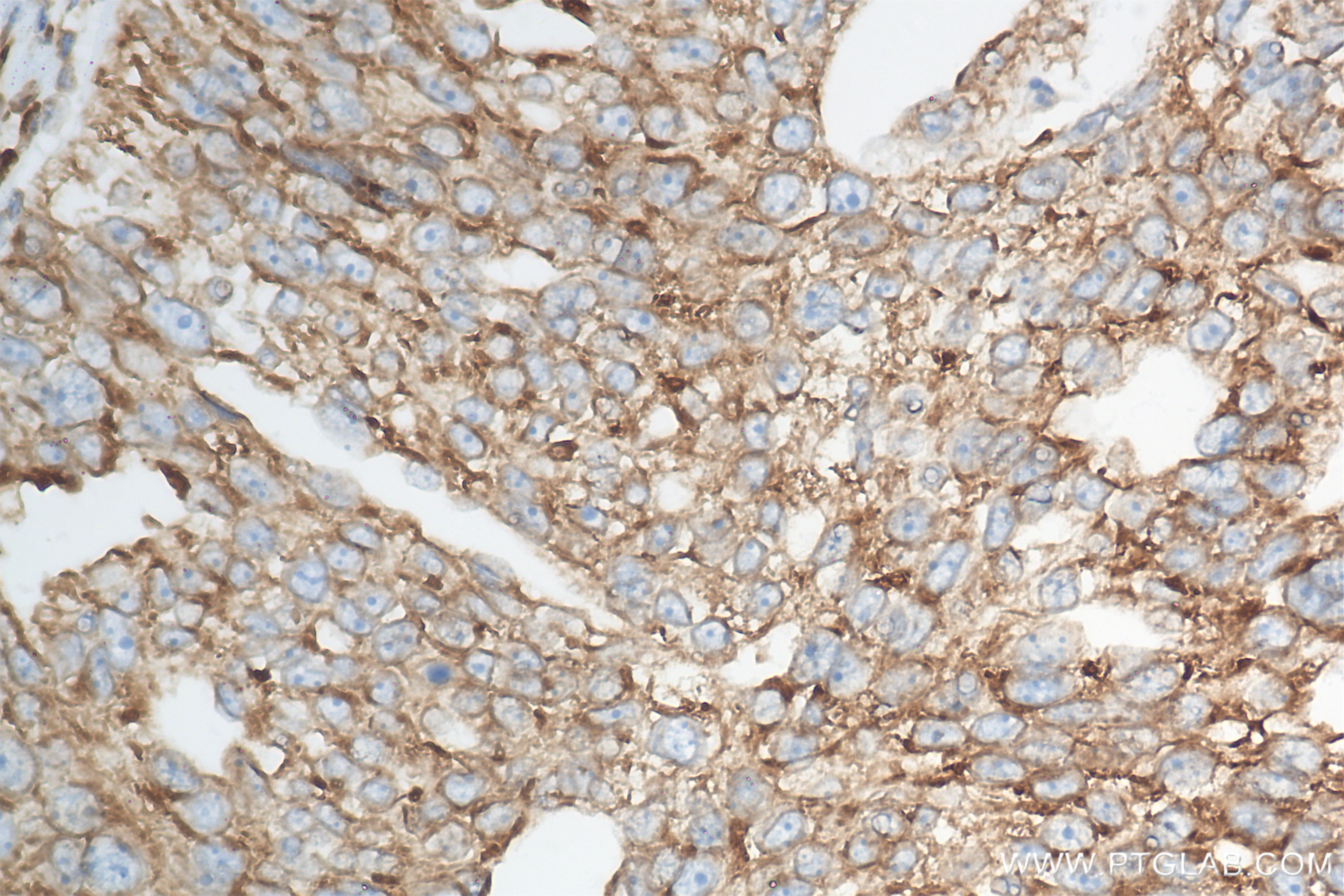 Immunohistochemistry (IHC) staining of human ovary cancer tissue using KTN1 Recombinant antibody (85681-4-RR)